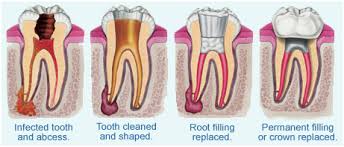 Root-Canals.jpg